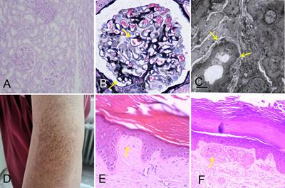 Case report: Complex paraneoplastic syndromes in thymoma with nephrotic syndrome, cutaneous amyloidosis, myasthenia gravis, and Morvan’s syndrome